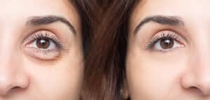 Before and after photo of woman who had puffy under eye bags and now has smooth skin around her eyes